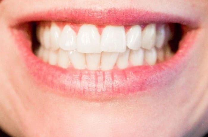 gebit witte tanden